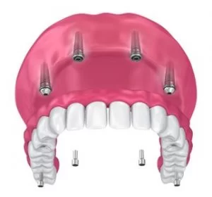 Implantom nošene proteze