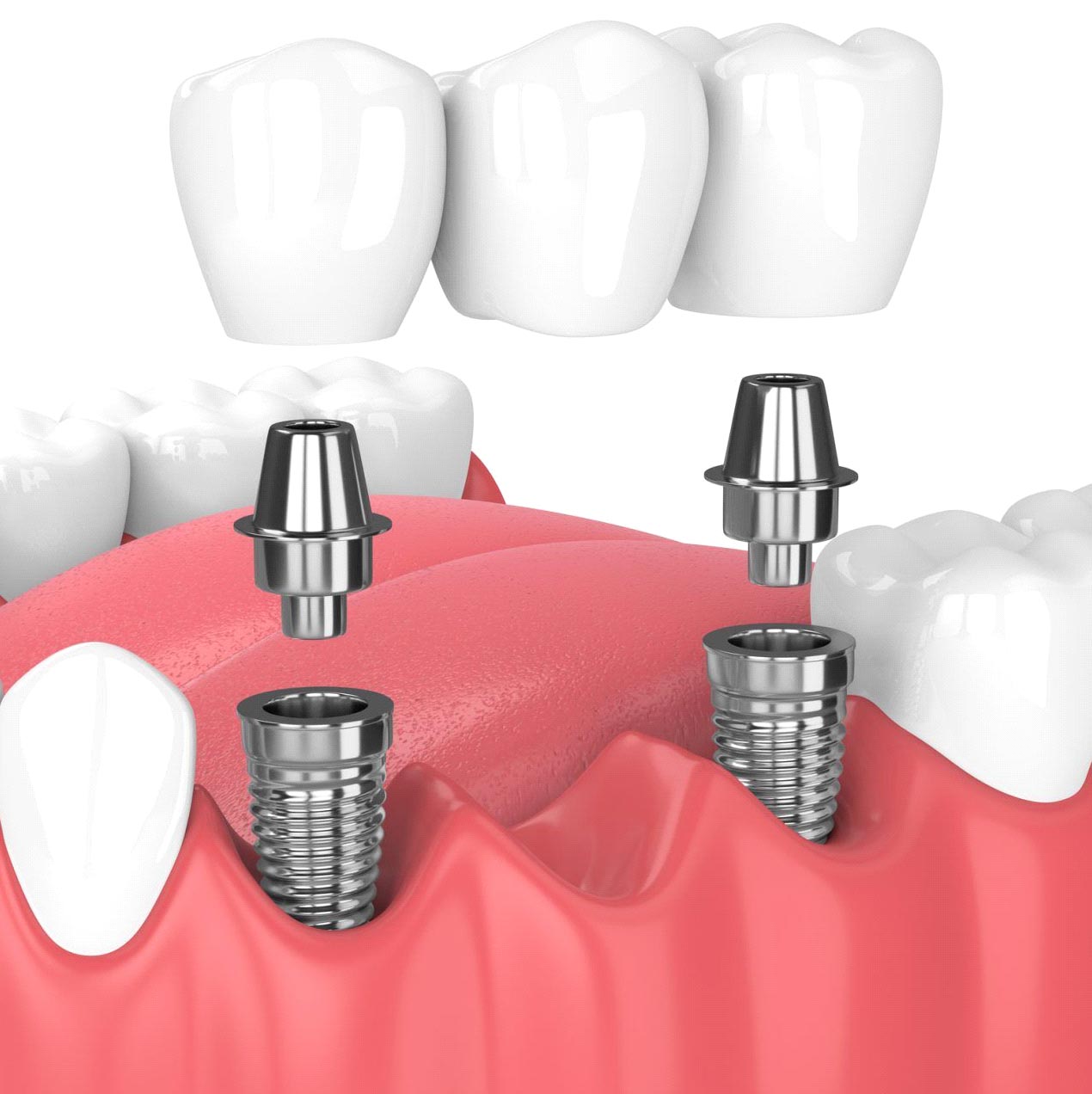 Implantom nošeni mostovi