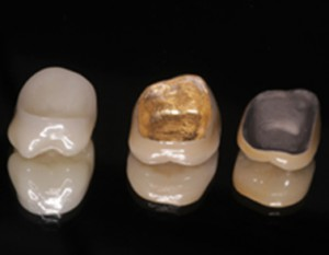 Zubne krunice-tipovi