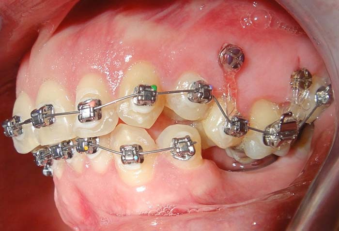 Tads - Studio dent 011